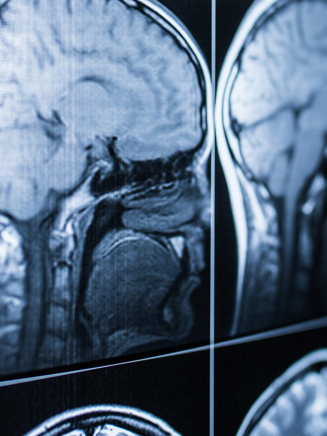 Traumatic Brain Injury In Texas