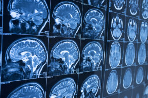 Why Choose The de la Garza Law Group for Help After Suffering a Brain Injury in Houston, TX?