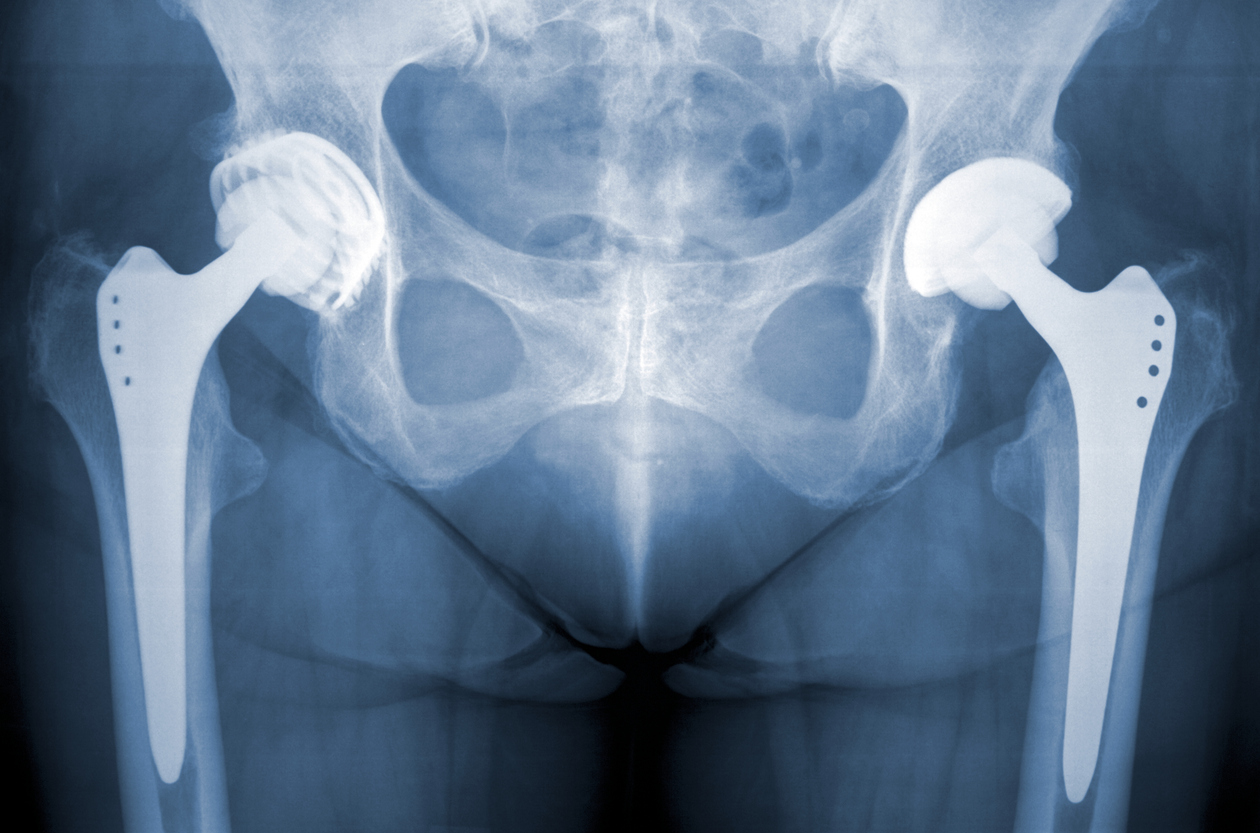 What Are the Symptoms of a Broken Tailbone?